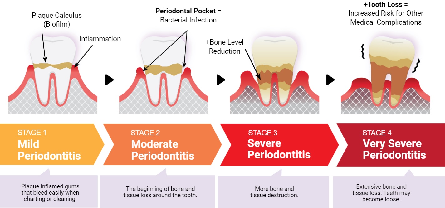 SimplyPerio Saliva Test – OsseoDent™
